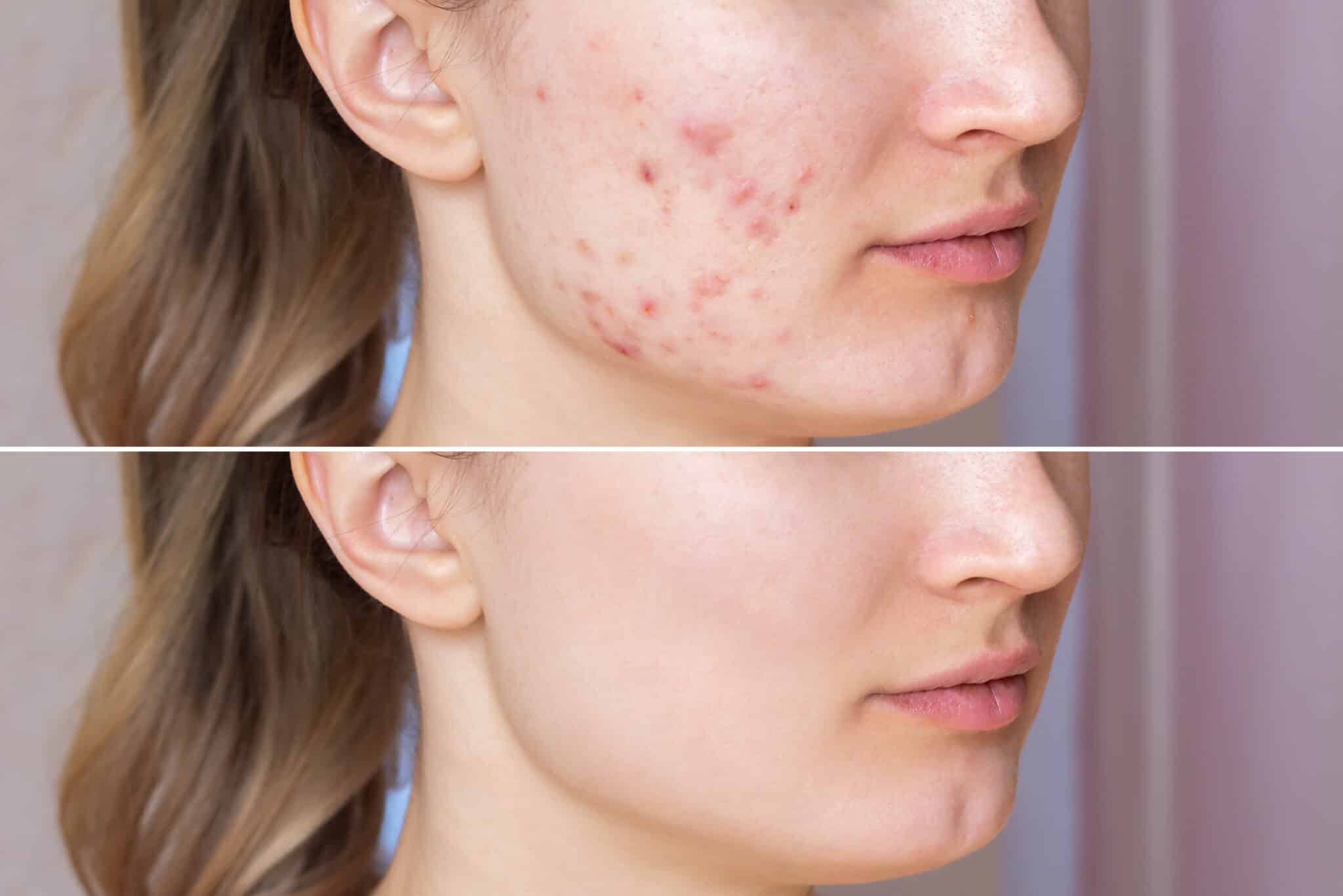 Cropped shot of a young woman's face before and after acne trea
